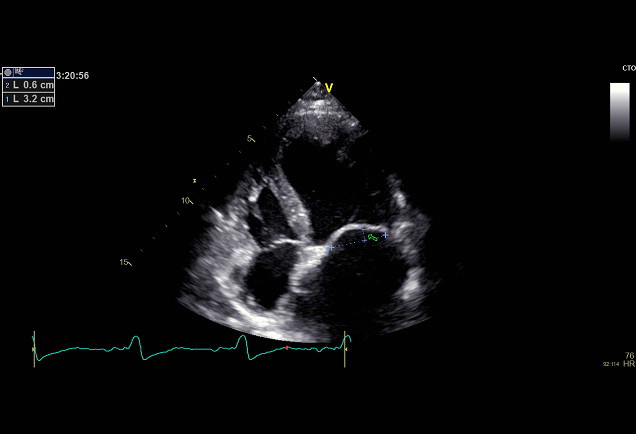 Figure 3: Coaptation Depth (CD)- Distance between leaflet coaptation and
the mitral annulus plane.